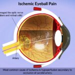 Cross-section diagram of a human eye showing damage from Ocular Ischemic Syndrome.